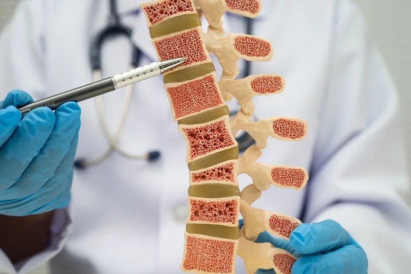 Tratamiento de estenosis del canal vertebral